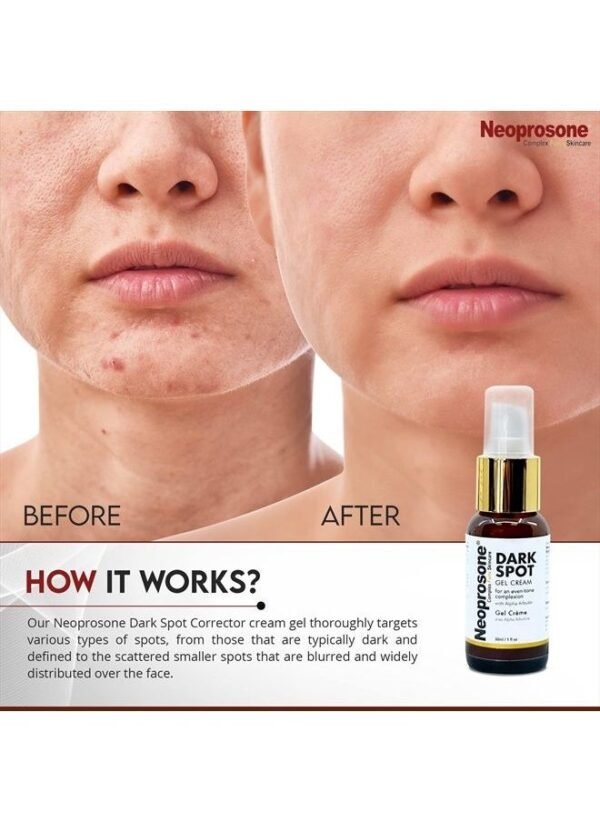 Neoprosone , Dark Spot Remover for Face - 1 Fl oz / 30 ml - Hyperpigmentation Cream, Reduce Dark Spots, Sun Spots, Brown Spots on: Face, Knees, Elbows, Hands, Private Areas - Image 4